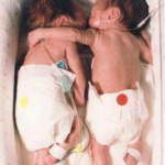 L’abbraccio di due gemelle premature 
